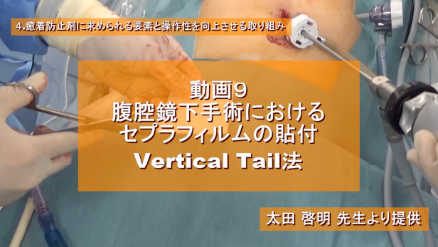 腹腔鏡下手術におけるセプラフィルムの貼付 Vertical Tail法