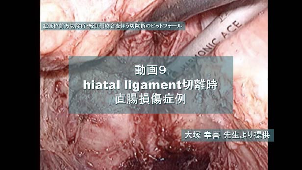 hiatal ligament切離時直腸損傷症例
